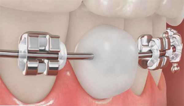 orthodontics vax 2 - موم ارتودنسی